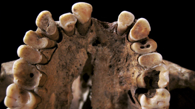 Higiene bucal: cáries e abcessos foram encontrados nos esqueletos estudados