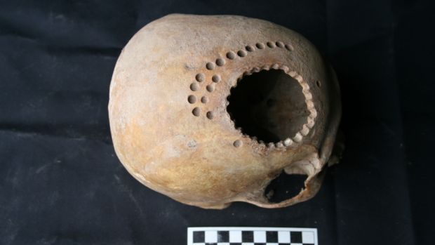 Crânio com perfurações encontrado no Peru. O procedimento deveria atravessar todo o osso, sem tocar o cérebro
