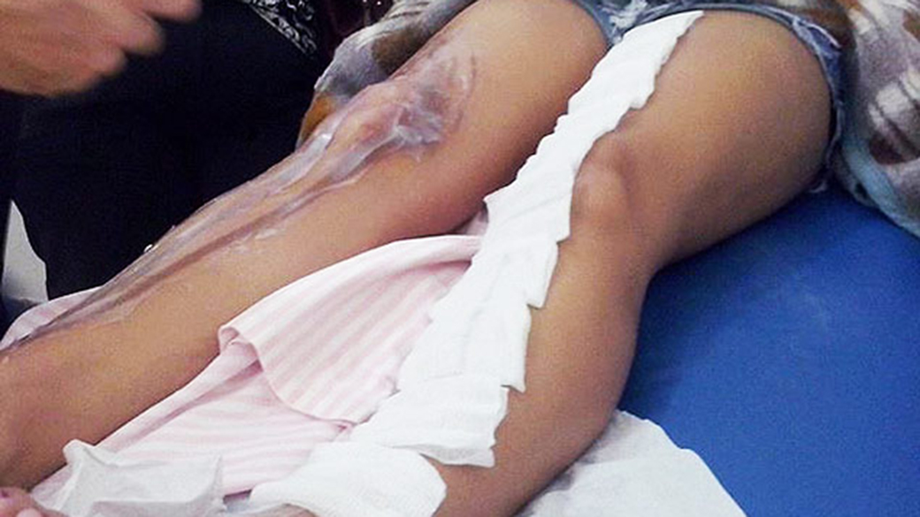 Estudante de Adamantina, em São Paulo, teve queimaduras graves nas pernas durante trote violento na faculdade