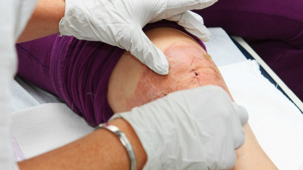 Em feridas epiteliais crônicas, como acontece em pacientes diabéticos, o processo de cicatrização da pele não é suficiente para que haja uma cura do machucado
