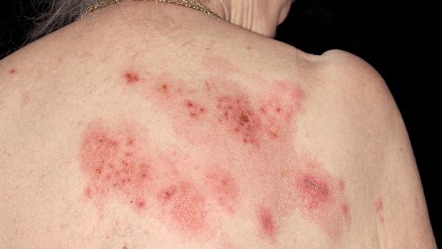 Ministério da Saúde pede incorporação de vacina contra o herpes-zóster ao SUS