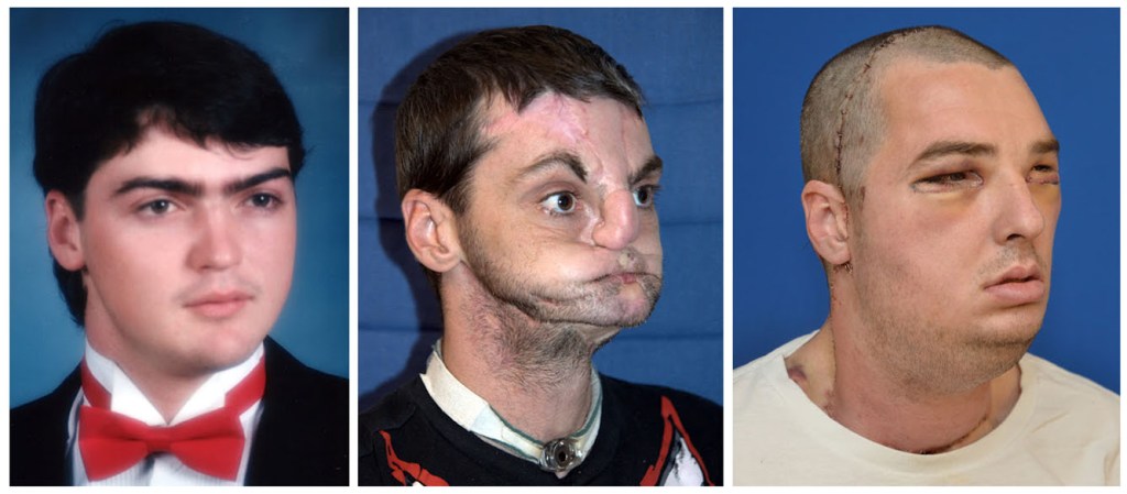 Imagem divulgada pelo centro médico da Universidade de Maryland mostram Richard Lee Norris, homem que recebeu um transplante facial após grave acidente com uma arma de fogo