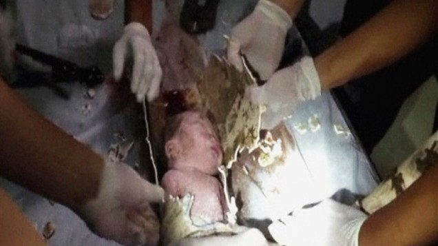 Bebê recém-nascido que foi jogado no vaso sanitário de um prédio residencial no leste da China