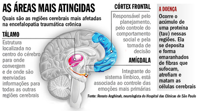 As área mais atingidas - Quais são as regiões cerebrais mais afetadas na encefalopatia traumática crônica