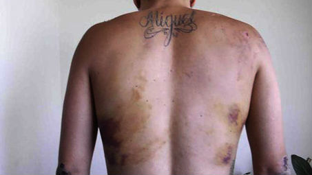 Jovem venezuelano que disse ter sido torturado mostra as marcas da agressão