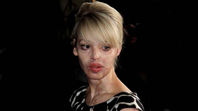 Katie Piper, aparição de 2010. Ela teve seu rosto queimado por ácido a mando de seu ex-namorado, em 2008
