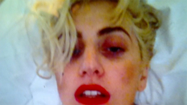 Lady Gaga mostra olho roxo no Twitter