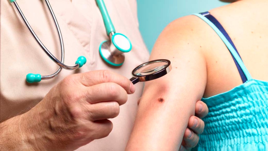 Médico examina paciente com melanoma