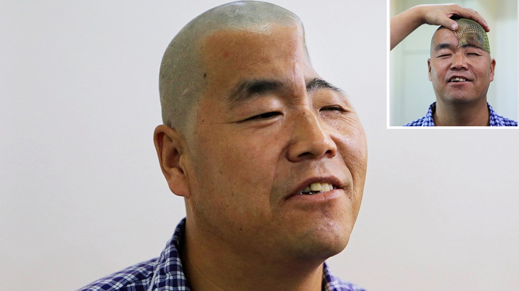 Paciente é examinado antes de ser submetido à cirurgia que vai implantar tela de titânio produzida por uma impressora 3D em sua cabeça