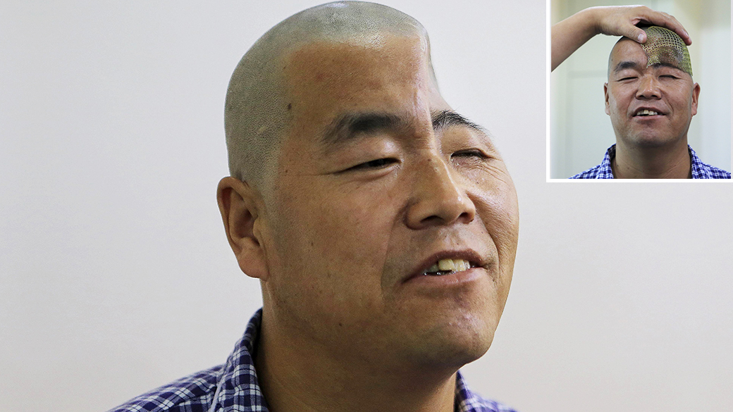 Paciente é examinado antes de ser submetido à cirurgia que vai implantar tela de titânio produzida por uma impressora 3D em sua cabeça