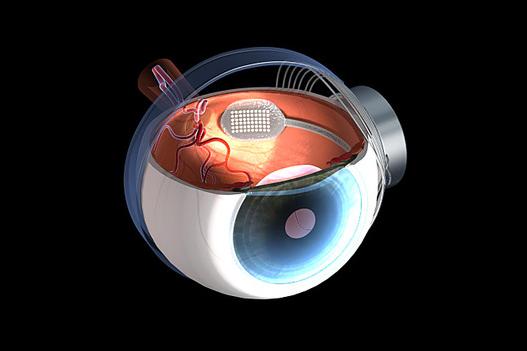 Ilustração mostra onde o receptor é implantado