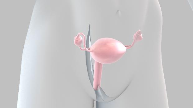 Câncer de ovário: nova descoberta genética pode levar a novos tratamentos para a doença