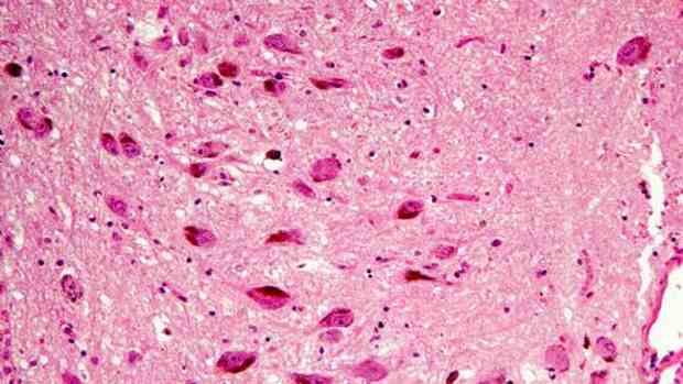 Imagem do cérebro ampliada 50 vezes mostra sinais da doença de Parkinson