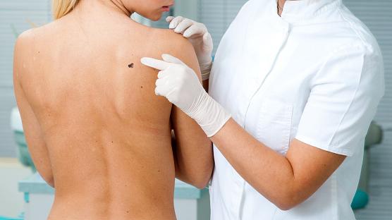 A combinação de duas terapias contra o câncer conseguiu diminuir tumores em cerca de 60% de pacientes com melanoma em estágio avançado