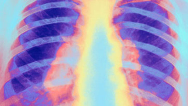 Fibrose cística: Com a doença, secreção pode se acumular nas vias aéreas e desencadear doenças graves nos pulmões