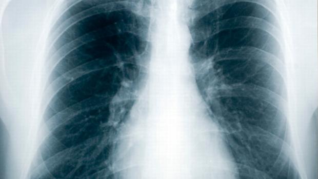 A imagem de raio-x mostra um pulmão com tuberculose