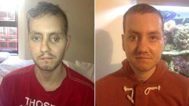 O britânico Stephen Poder, que teve seu rosto desfigurado após acidente de moto, antes e depois de passar por uma cirurgia de reconstrução facial feita com impressora 3D