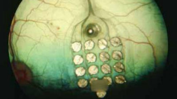 Imagem demonstra grade de eletrodos implantados diretamente na retina