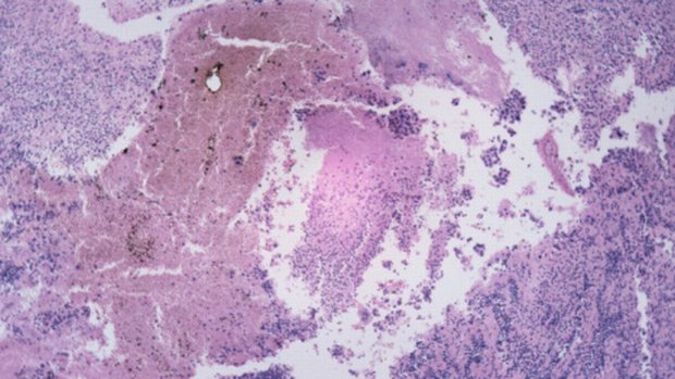 Imagem microscópica de câncer de pele