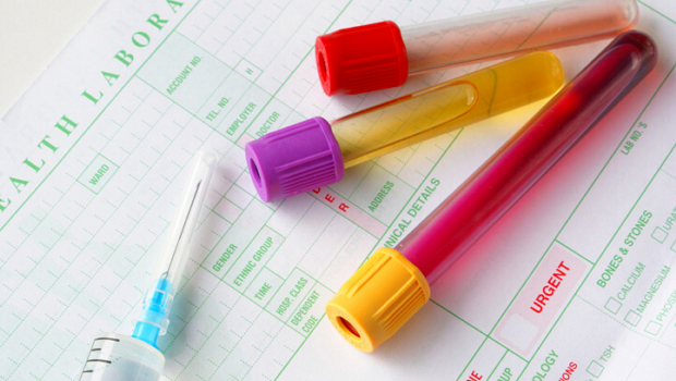 Teste de urina poderá realizar diagnóstico precoce de câncer
