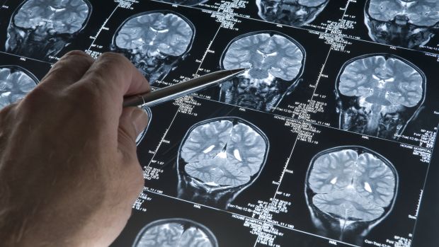 Tomografia: resultados do exame do cérebro podem ajudar o médico a decidir se o melhor para o paciente com depressão é a psicoterapia ou são os remédios antidepressivos