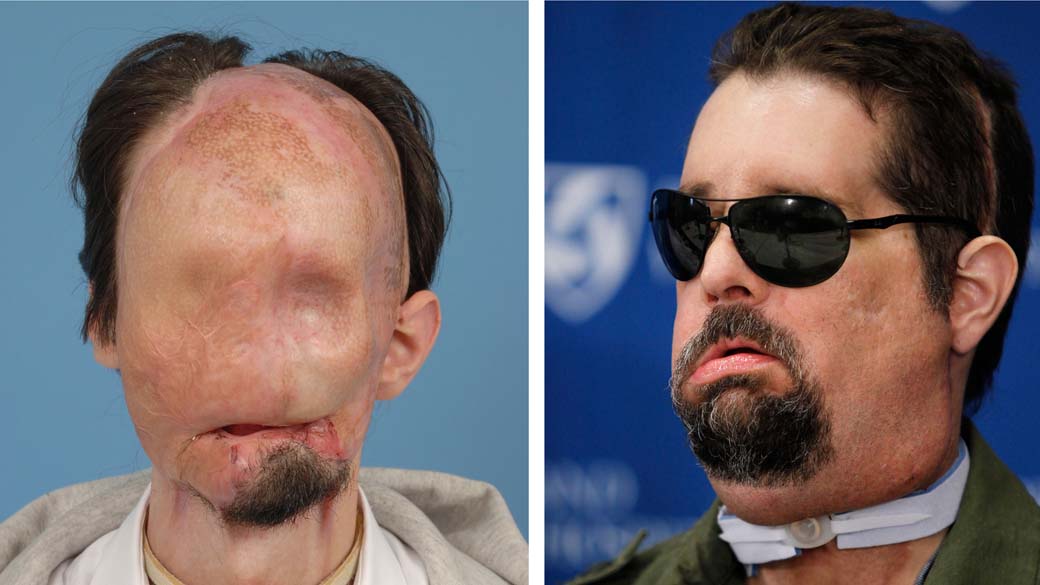 Antes e depois: Dallas Wiens antes do transplante, realizado em março deste ano, e nesta segunda-feira, durante aparição pública em Boston