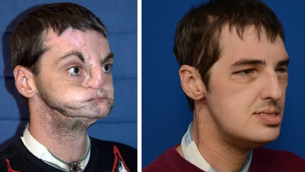 Richard Lee Norris após o acidente e sete meses depois de ser submetido ao transplante facial