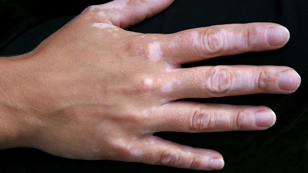 Vitiligo: condição que leva à perda de pigmentos, resultando em manchas brancas irregulares na pele