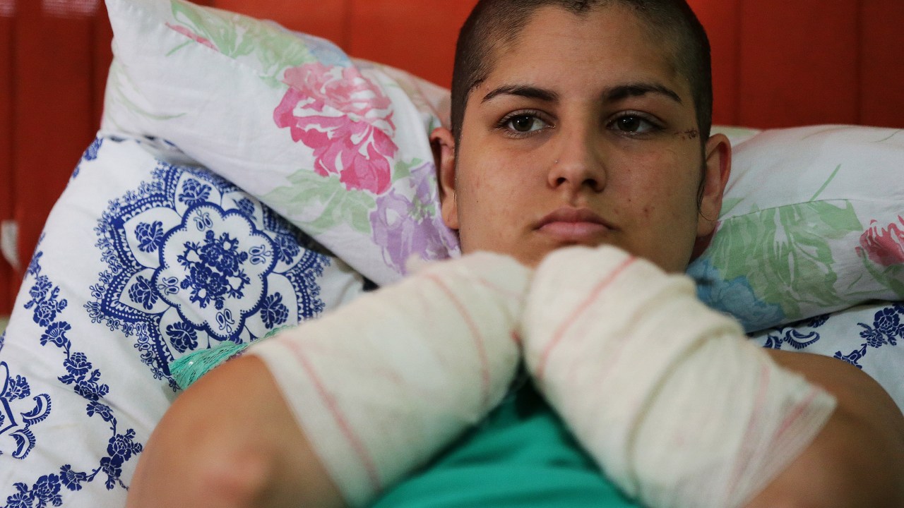 Gisele Santos, 22 anos, teve as mãos e parte de um dos pés decepados pelo companheiro no município de São Leopoldo, no Rio Grande do Sul - 12/08/2015