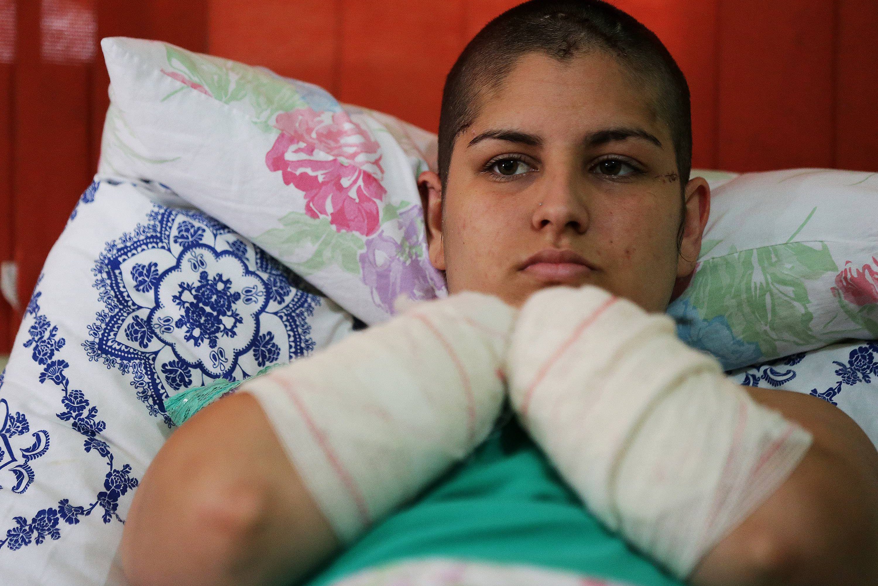 Gisele Santos, 22 anos, teve as mãos e parte de um dos pés decepados pelo companheiro no município de São Leopoldo, no Rio Grande do Sul. O crime aconteceu em 02 de agosto - 11/08/2015