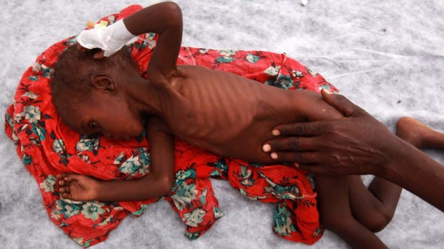 Criança desnutrida em hospital em Mogadíscio, Somália