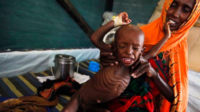 Em foto de 2016, criança somali desnutrida em clínica da organização Médicos Sem Fronteiras na cidade de Dadaab, no Quênia
