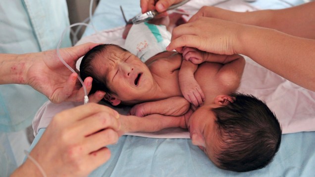 Médicos examinam recém-nascidos siameses em Urumqi, na China