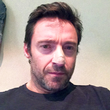 O ator Hugh Jackman, ao anunciar ter descoberto um câncer de pele no nariz