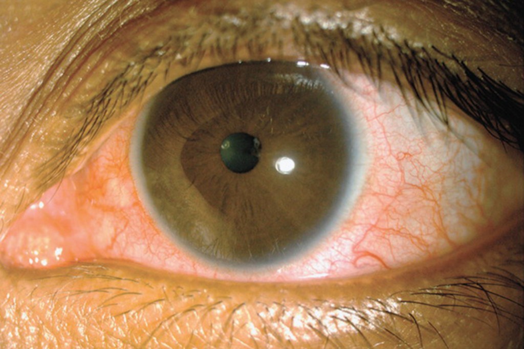 Olho de um paciente com zika vírus