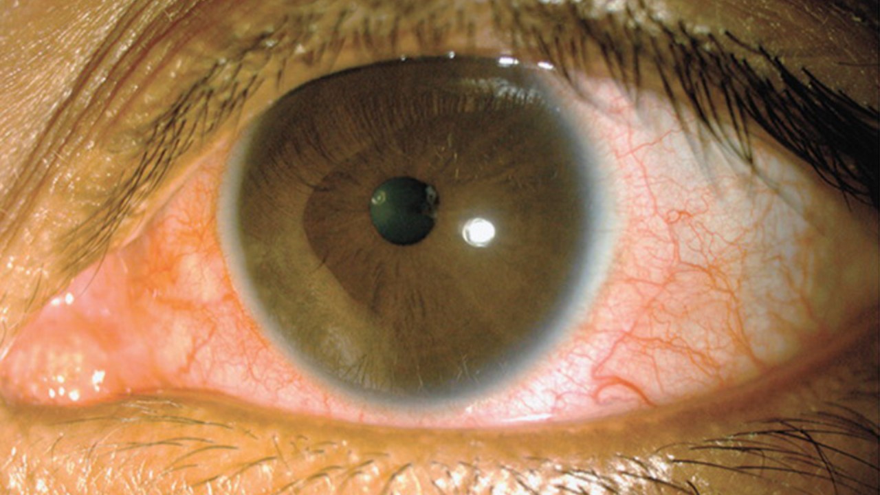 Olho de um paciente com zika vírus