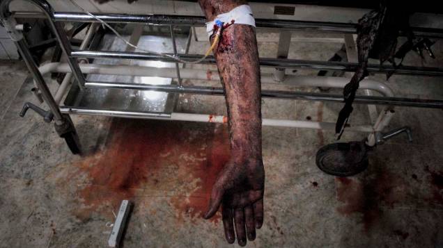 Vítima de explosão gravemente ferida no hospital de Peshawar, Paquistão