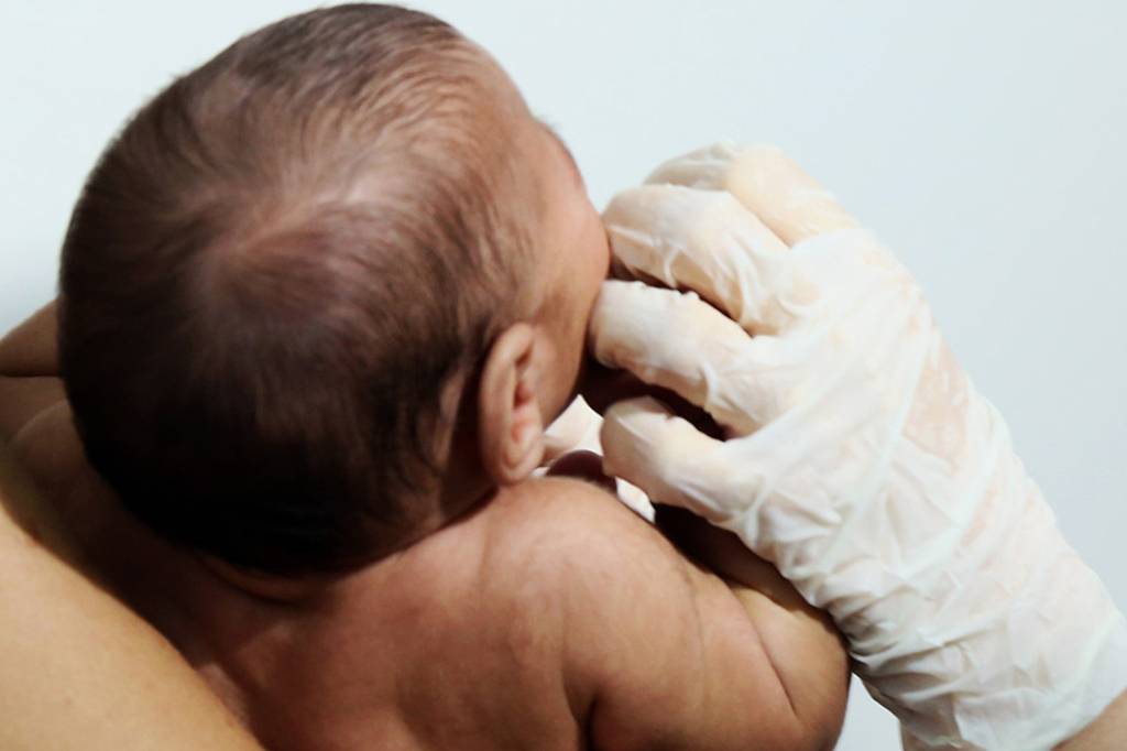 Zika: sequelas da doença podem surgir em bebês após os 2 anos de idade