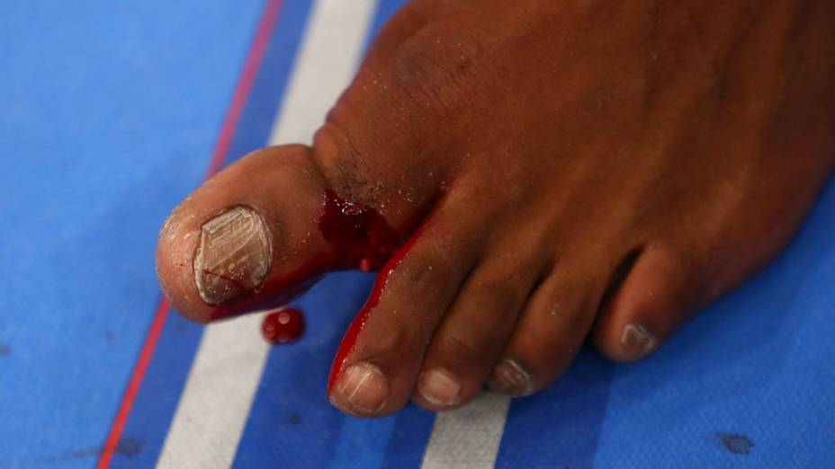 UFC 159: a lesão no dedão de Jon Jones durante a luta contra Chael Sonnen