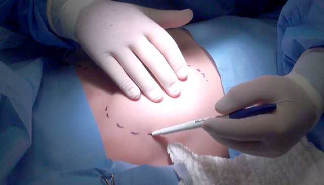 Implante de silicone