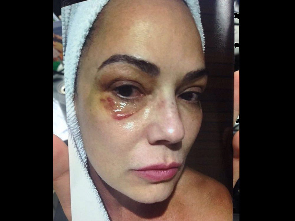 Luiza Brunet em foto feita após agressão que ela afirma ter sofrido do ex, Lírio Parisotto