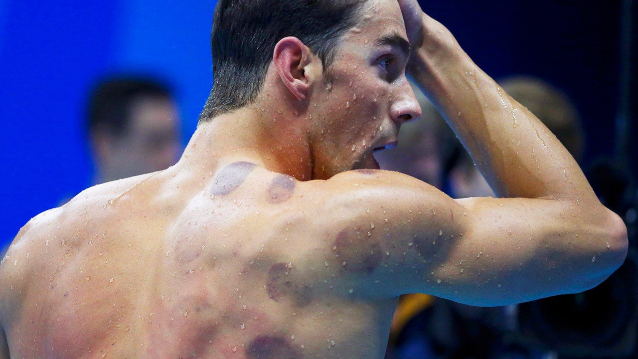 O nadador americano Michael Phelps, é visto com várias manchas em suas costas, durante a prova de 200m nado borboleta, no Centro Aquático Olímpico - 08/08/2016