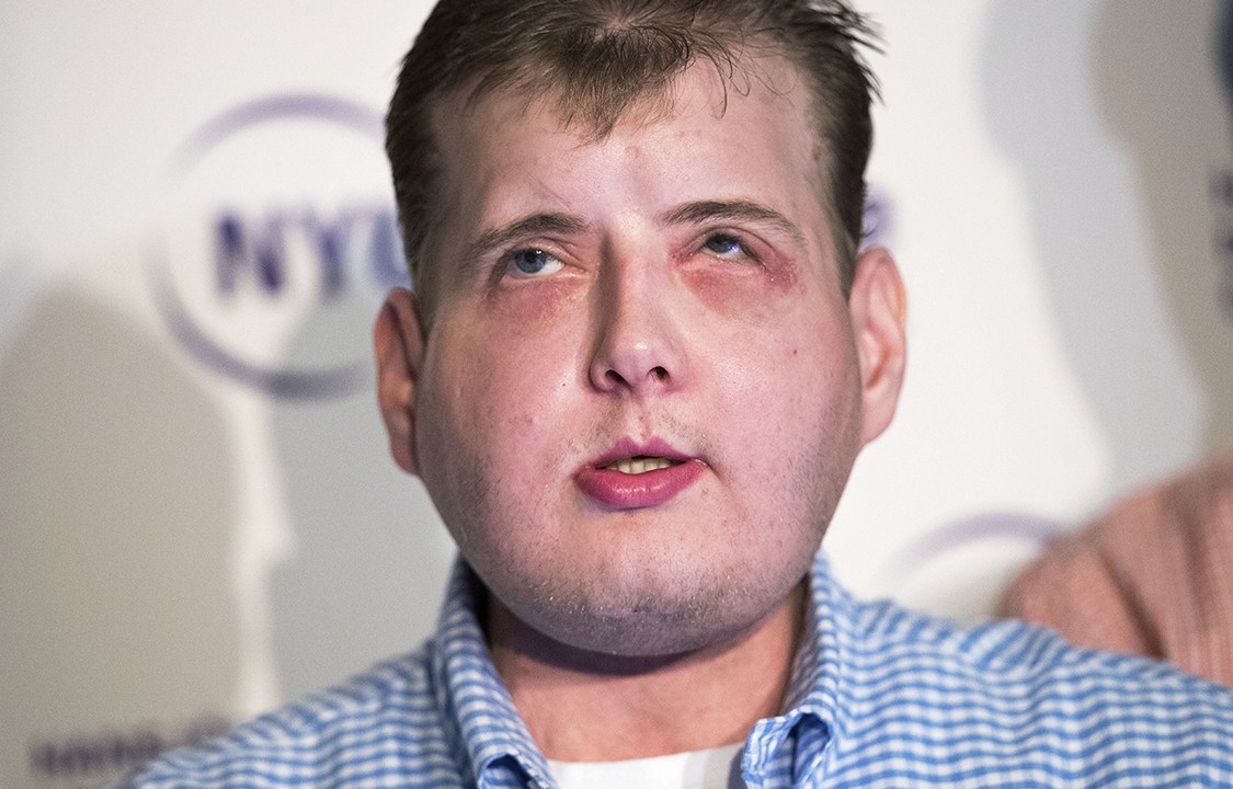 Bombeiro Patrick Hardison passou por um complexo transplante de rosto após sofrer severas queimaduras em 2001