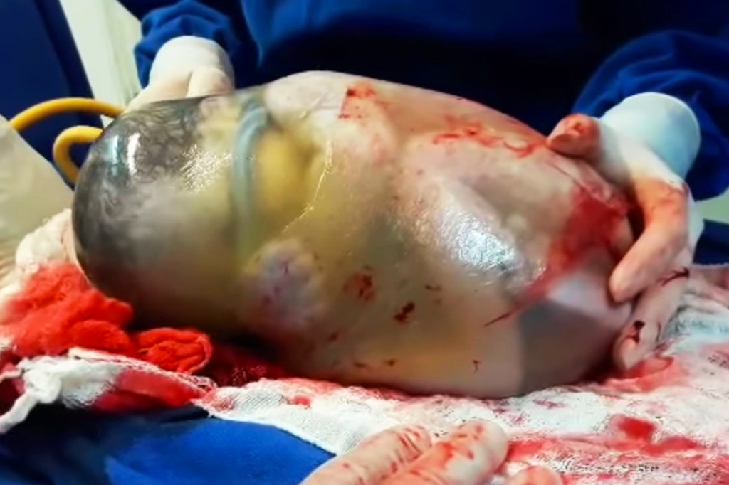 Bebê nasce dentro de saco aminiótico, em Barretos (SP)