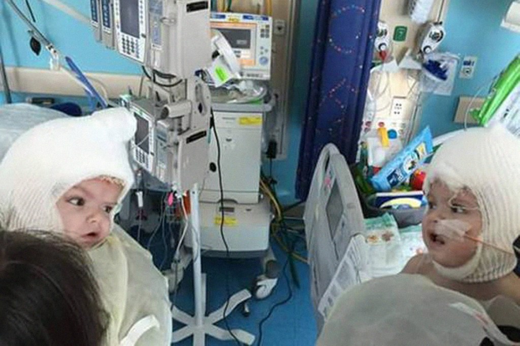 Siameses Jadon e Anias McDonald se olham pela primeira vez após cirurgia de separação