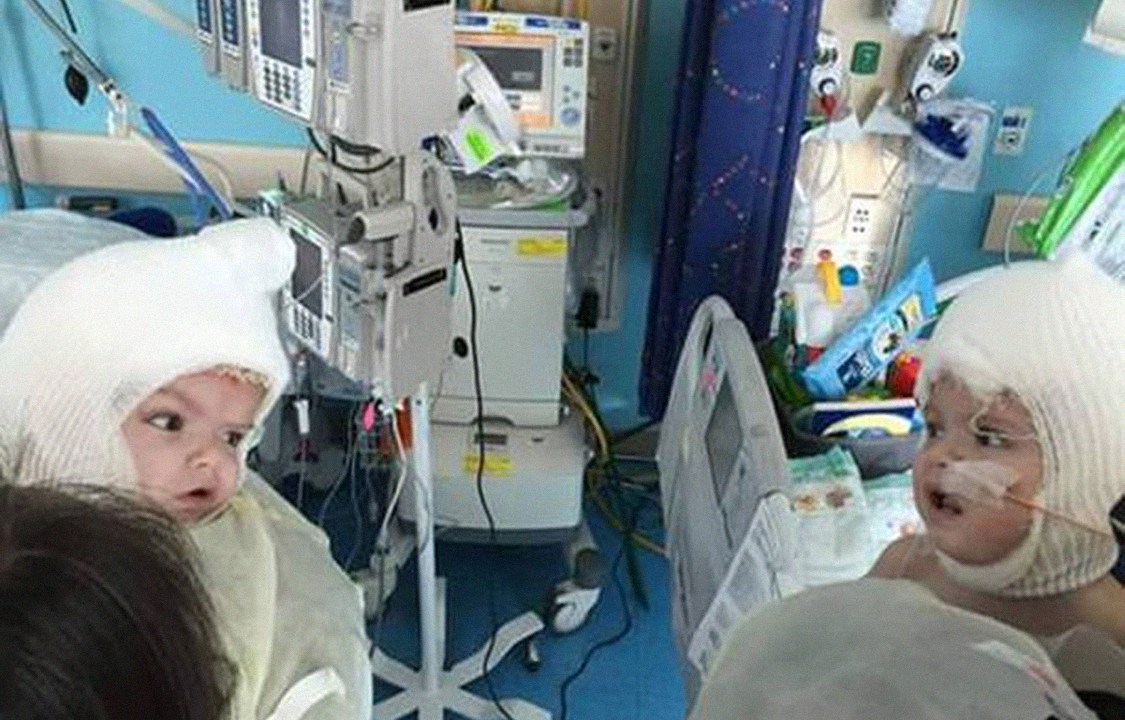 Siameses Jadon e Anias McDonald se olham pela primeira vez após cirurgia de separação