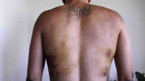 Jovem-venezuelano-que-disse-ter-sido-torturado-mostra-as-marcas-da-agressao-size-598