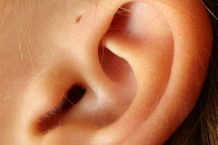 Saúde: Sinus pré-auricular