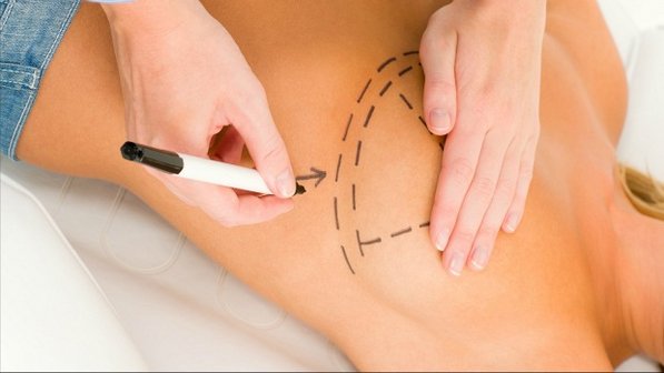 Próteses de silicone: é preciso trocá-las de tempos em tempos?