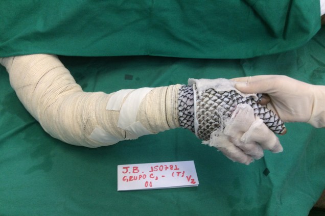 <span>Colocação da pele para tratamento das queimaduras em pacientes do Instituto José Frota, em Fortaleza. </span>